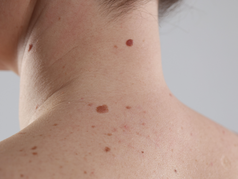 Skin Cancer Checks & Excisions